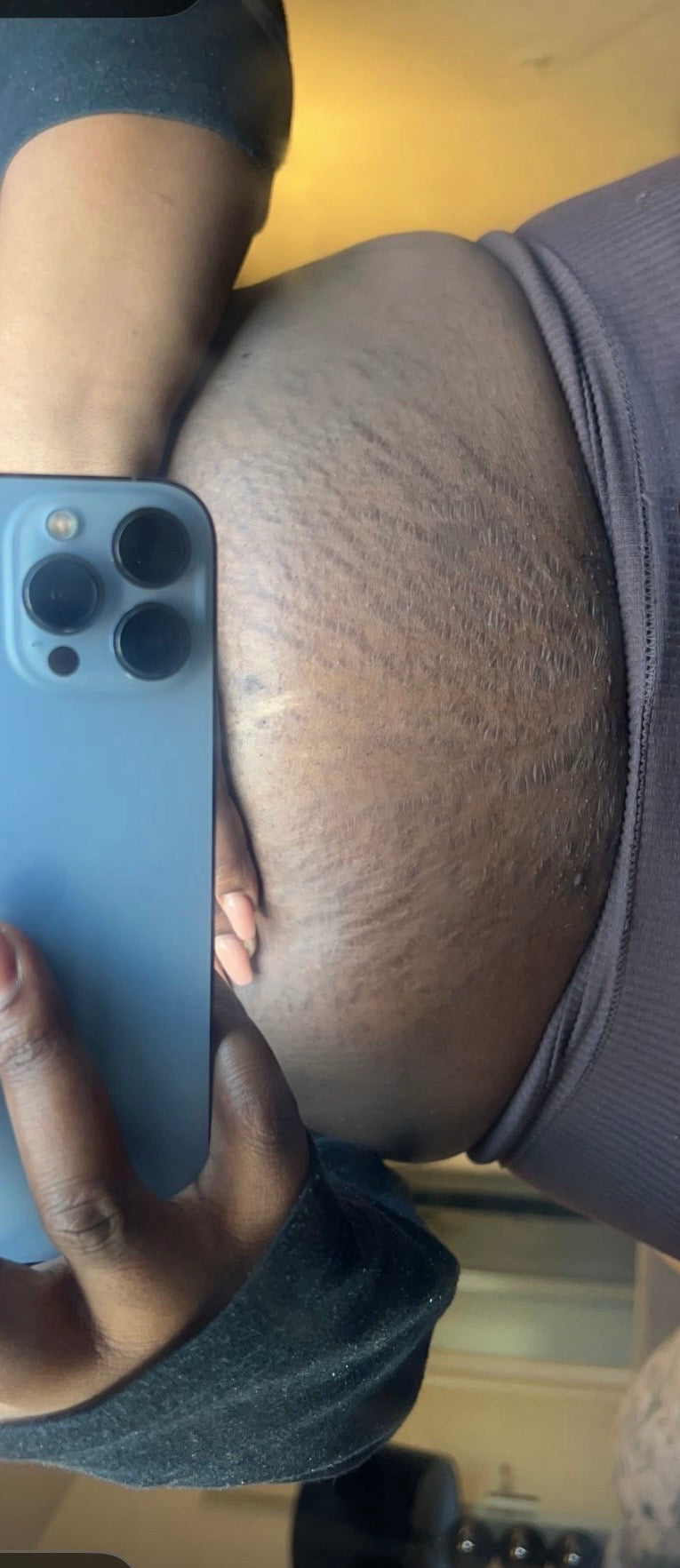 Stretch Mark Oil