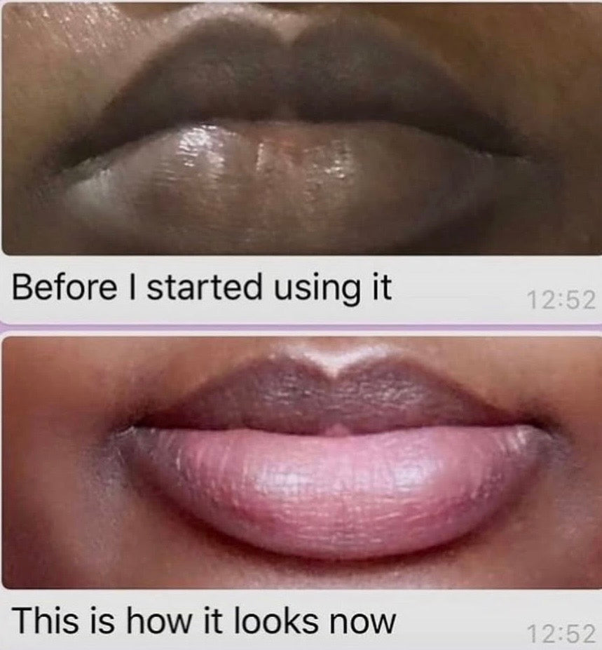 Lip Lightening Treatment